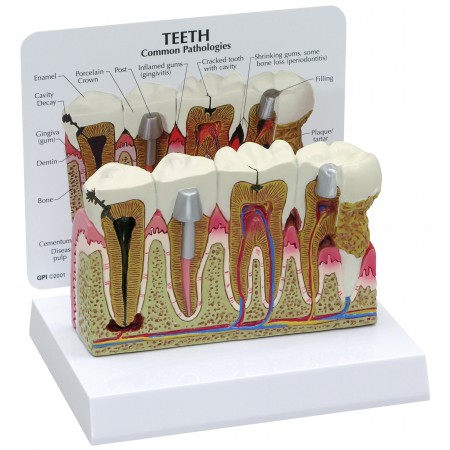 Teeth with Common Pathologies