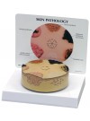 Skin Cancer