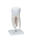 3B Giant Molar with Dental Caries, 15X Life-Size - 6 Parts